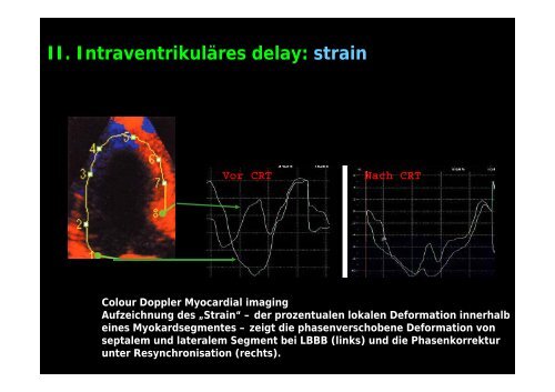 InterventrikulÃ¤res delay - Tschwalm.de