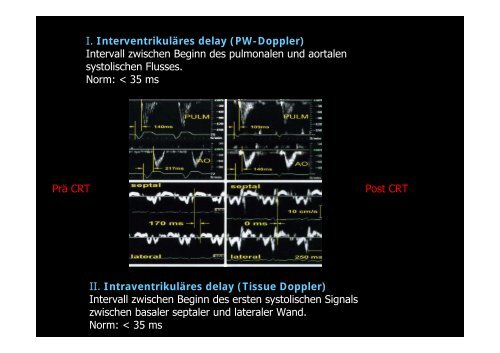 InterventrikulÃ¤res delay - Tschwalm.de