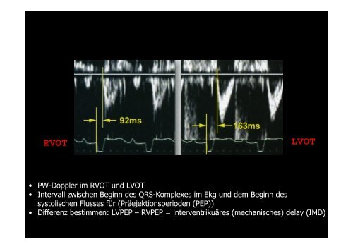 InterventrikulÃ¤res delay - Tschwalm.de