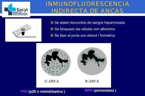 ANCAS en las vasculitis.