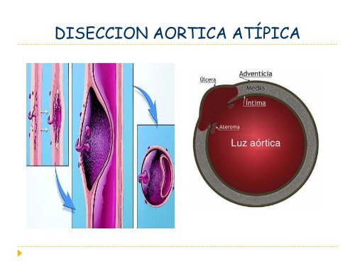 clase diseccion aortica dra. rosario herrera - Departamento de ...