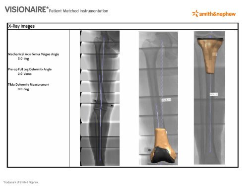 VISIONAIRE Patient Matche