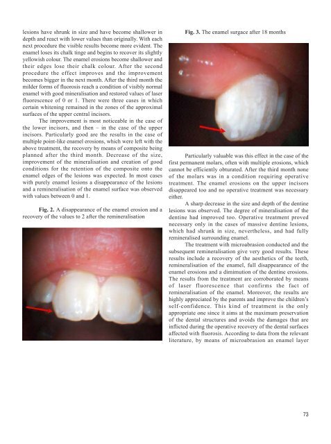 TREATMENT OF DENTAL FLUOROSIS - Journal of IMAB