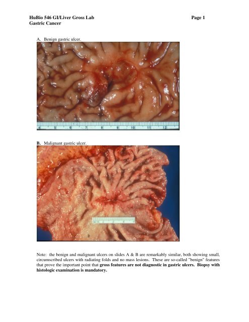 Gastric Ulcers and Carcinoma - Pathology