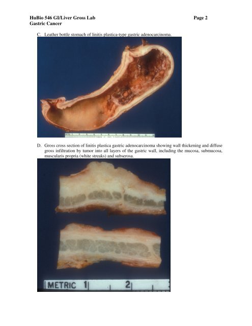 Gastric Ulcers and Carcinoma - Pathology