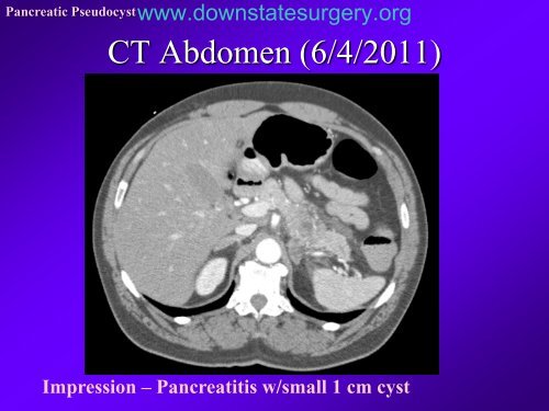 Pancreatic Pseudocyst