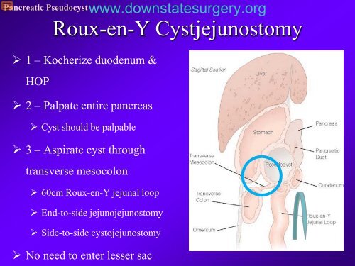 Pancreatic Pseudocyst