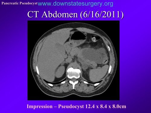 Pancreatic Pseudocyst