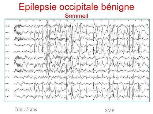 Epilepsie et Sommeil chez l'enfant - SFRMS