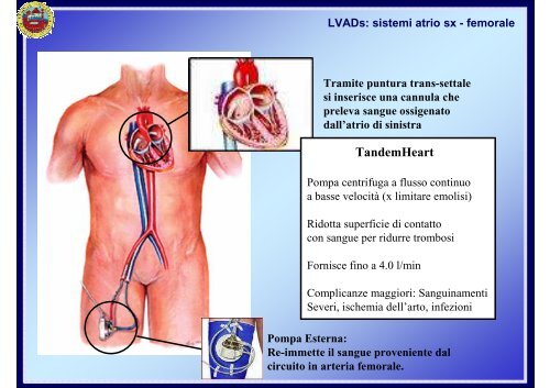 Il Contropulsatore Aortico - Cuorediverona.it