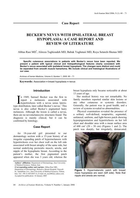 BECKER'S NEVUS WITH IPSILATERAL BREAST HYPOPLASIA: A ...