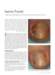 Ingrown Toenails - Cutis