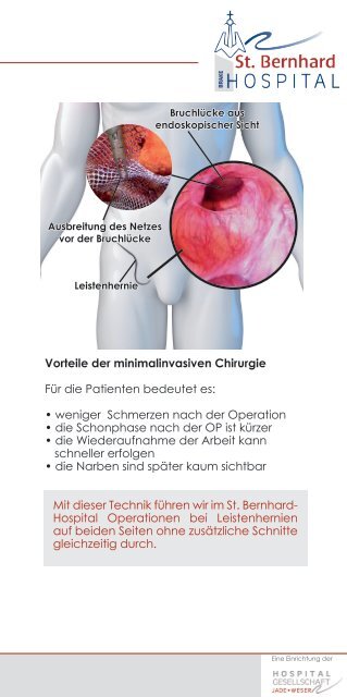 Leistenhernien Patienteninformation - Krankenhaus Brake