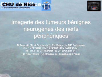 Imagerie des tumeurs bÃ©nignes neurogÃ¨nes des nerfs pÃ©riphÃ©riques