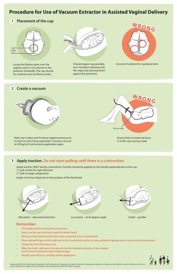 Procedure for Use of Vacuum Extractor in Assisted Vaginal - IAWG