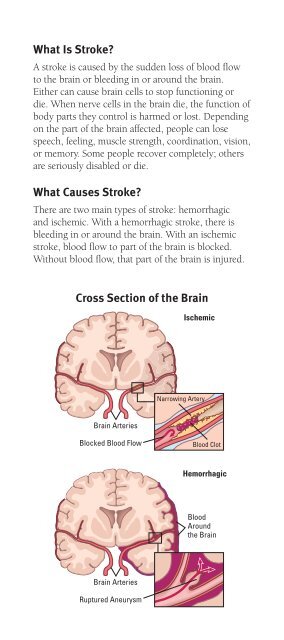 Stroke - American Academy of Neurology