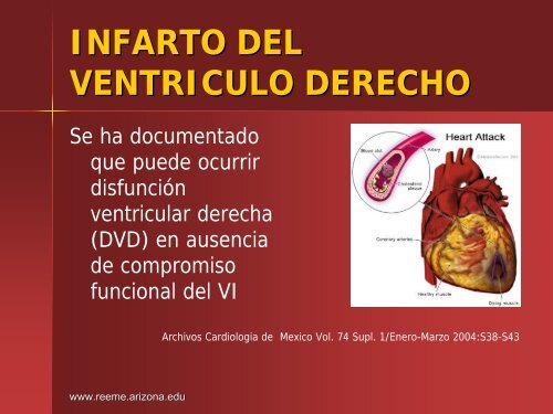 Infarto del Ventriculo Derecho - Reeme.arizona.edu