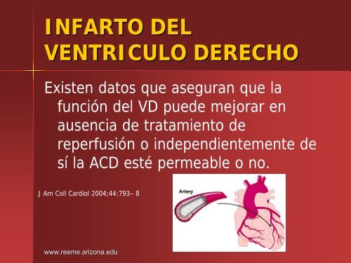 Infarto del Ventriculo Derecho - Reeme.arizona.edu