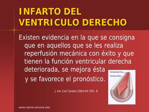 Infarto del Ventriculo Derecho - Reeme.arizona.edu