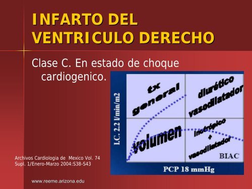 Infarto del Ventriculo Derecho - Reeme.arizona.edu