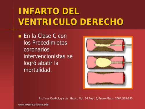 Infarto del Ventriculo Derecho - Reeme.arizona.edu