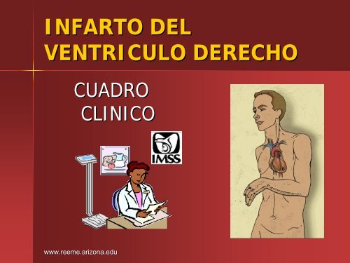 Infarto del Ventriculo Derecho - Reeme.arizona.edu