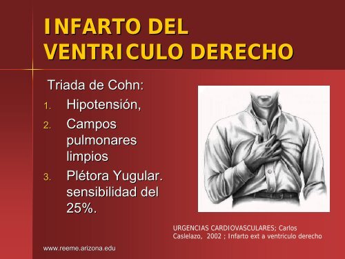 Infarto del Ventriculo Derecho - Reeme.arizona.edu