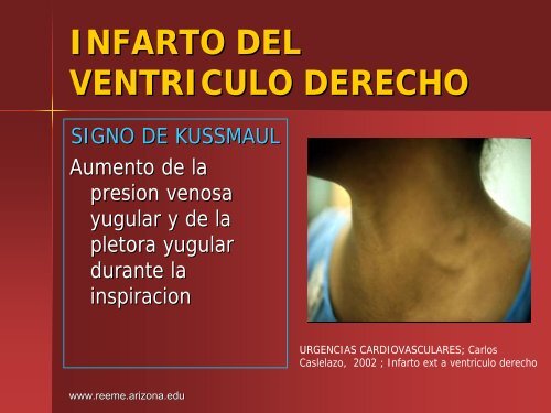 Infarto del Ventriculo Derecho - Reeme.arizona.edu