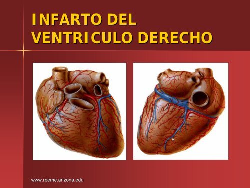 Infarto del Ventriculo Derecho - Reeme.arizona.edu