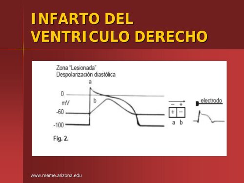 Infarto del Ventriculo Derecho - Reeme.arizona.edu