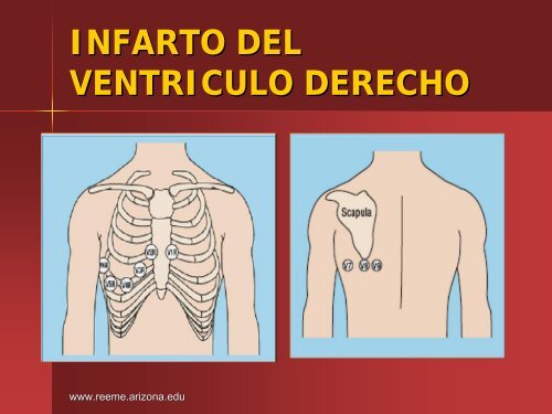 Infarto del Ventriculo Derecho - Reeme.arizona.edu