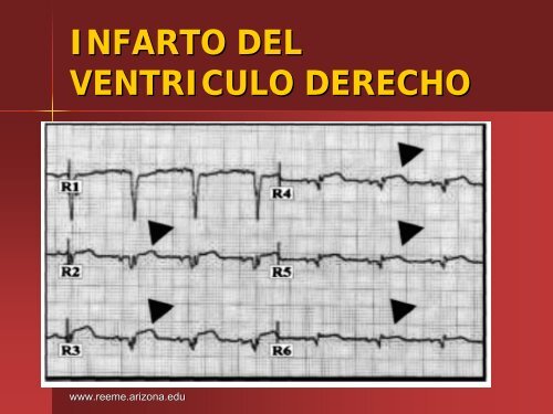 Infarto del Ventriculo Derecho - Reeme.arizona.edu