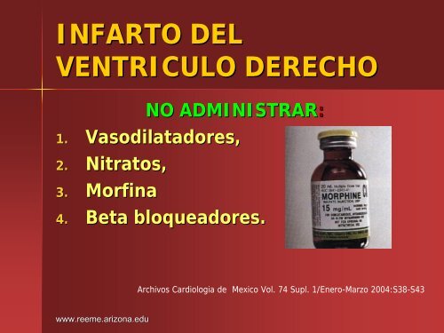 Infarto del Ventriculo Derecho - Reeme.arizona.edu