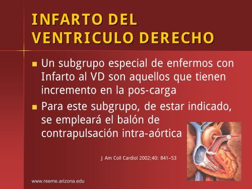 Infarto del Ventriculo Derecho - Reeme.arizona.edu