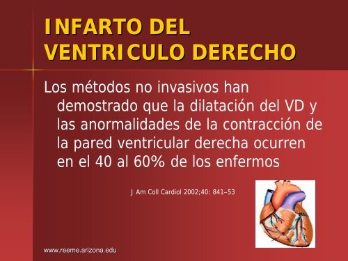 Infarto del Ventriculo Derecho - Reeme.arizona.edu