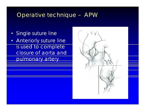 Aortopulmonary Window and Associated Anomalies