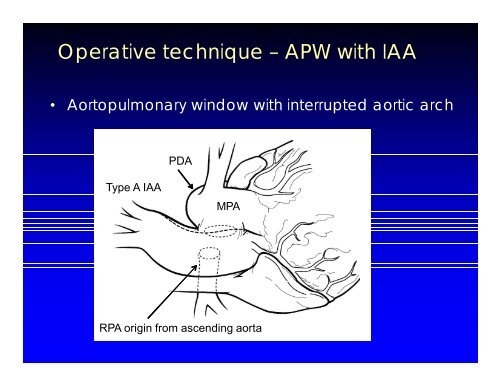 Aortopulmonary Window and Associated Anomalies