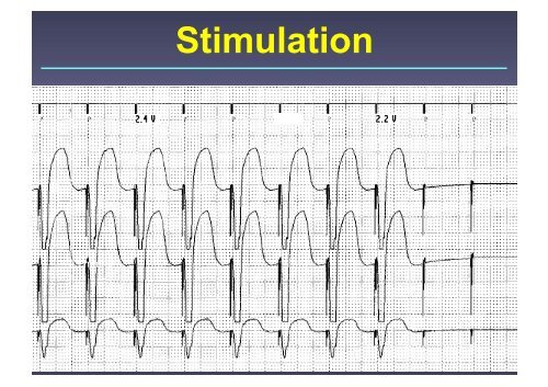 Herzschrittmacher: Basics und EKG-Workshop - Vivantes