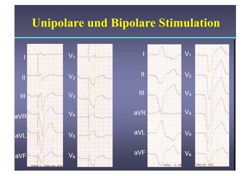 Herzschrittmacher: Basics und EKG-Workshop - Vivantes