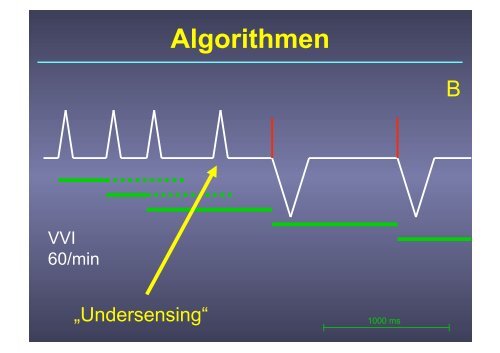 Herzschrittmacher: Basics und EKG-Workshop - Vivantes