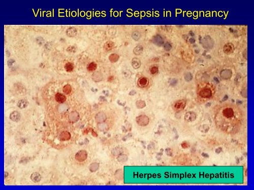 Sepsis and Septic Shock in Pregnancy - Children's Memorial ...