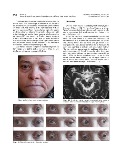 Midbrain Infarction Presenting with Weber's Syndrome and Central