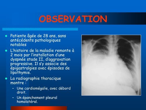 le diverticule gÃ©ant de l'oreillette droite fissurÃ© dans la plÃ¨vre