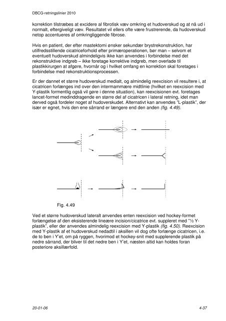 4 Kirurgisk behandling - DBCG