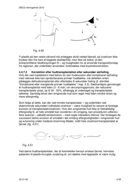 4 Kirurgisk behandling - DBCG