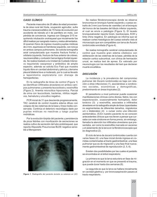 Ascaris pulmonar en paciente politraumatizado - Asoneumocito