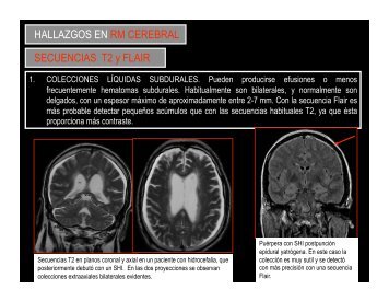 HALLAZGOS EN RM CEREBRAL SECUENCIAS T2 y FLAIR