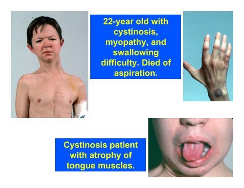 Adult Medical Issues in Cystinosis--William Gahl, M.D.