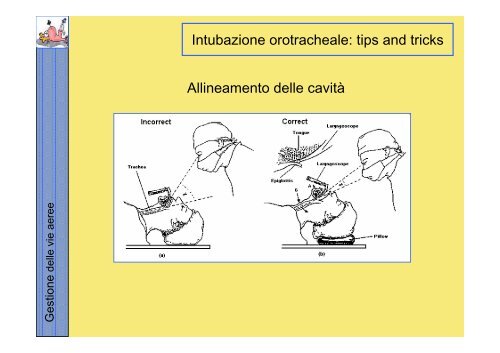 La gestione delle vie aeree PDF - Rossoemergenza