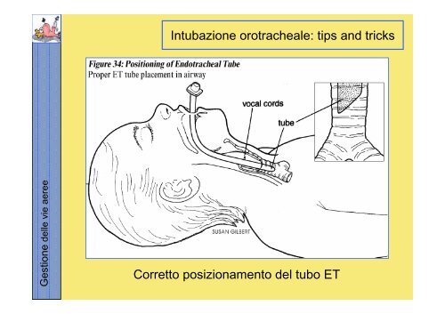 La gestione delle vie aeree PDF - Rossoemergenza